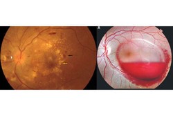 Hamil, Dua Wanita Ini Malah Kena Gangguan Mata Aneh