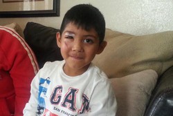 Kepala Terjepit di Eskalator, Wajah dan Kelopak Mata Bocah Ini Luka-luka