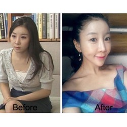 Gagal Operasi Plastik, Bisakah Diperbaiki? Ini Kata Dokter