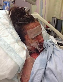 Gara-gara Alergi Obat, Kulit Wajah Gadis Ini Meleleh