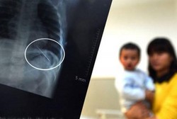 Batuk dan Demam Tinggi, Ternyata Ada Jarum di Paru-paru Lin Lin