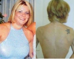 Niat Awal Ingin Kecilkan Payudara, Wanita Ini Malah Jadi Anoreksia