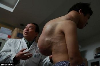 Yang Xiao, Pemuda yang Hidup dengan Tumor 10 Kg Selama Sepuluh Tahun