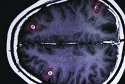 Gara-gara Minum Darah Babi, Otak Seorang Pemuda Jadi Sarang Cacing Pita