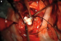 Astaga! Gigi Ditemukan di Otak Bayi dengan Tumor Ini