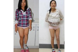 Digerogoti Bakteri, Kaki Wanita Asal China Ini Panjang Sebelah