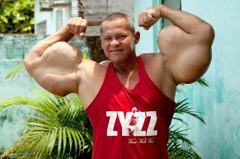 Arlindo, Punya Bisep Terbesar se-Brasil karena Disuntik Minyak dan Alkohol