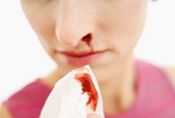 Kabut Asap Bisa Picu Hidung Mimisan? Ini Kata Dokter