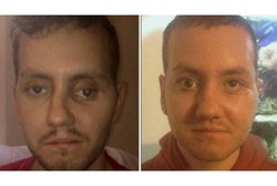 Berantakan Karena Kecelakaan Motor, Wajah Pria Ini Dipulihkan Printer 3D