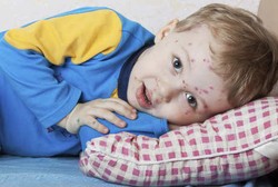 Tak Kena Cacar Air di Usia Anak-anak, Bagaimana Mencegahnya Saat Dewasa?