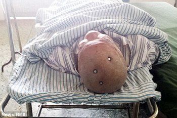 Pria Kepala Beton, Selamat Meski Paku Jumbo Tertancap di Tengkoraknya