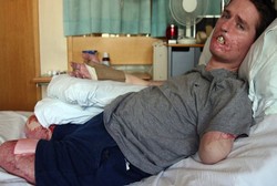 Bakteri Pemakan Daging Gerogoti Kaki, Lengan, dan Wajah Pria Ini