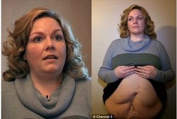 Ingin Langsing Saat Menikah, Perut Rachel Malah Berlubang dan Bernanah