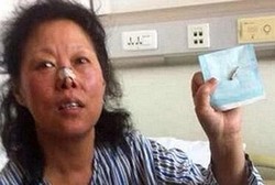 Luar Biasa! Ibu Ini Bertahan Hidup Meski 48 Tahun Peluru Bersarang di Kepala