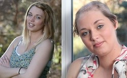 Stres Berat, Wanita Ini Menarik-narik Rambutnya Hingga Alami Kebotakan