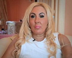 Lakukan Injeksi Filler, Bibir Wanita Ini Malah Bengkak Seperti Bola