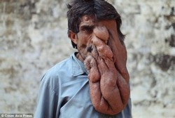 Manusia Gajah, Punya Belalai karena Tumor 4 Kg Bergelayut di Wajah