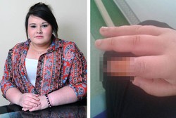 Ujung Jari Remaja Ini Membusuk Gara-gara Lem Kuku