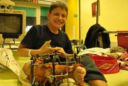 Kena Gangguan Tulang Langka, Remaja Ini Minta Kakinya Diamputasi