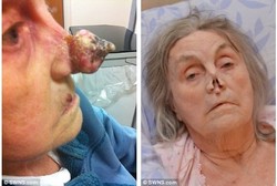 Nenek Berjuluk Pinocchio, Ternyata Ada Tumor Ganas di Hidung Panjangnya