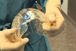 Wanita Ini Bertahan Hidup dengan Tulang Tengkorak Berbahan Plastik