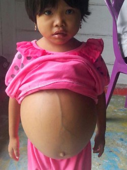 Mengidap Kanker, Perut Bocah Miskin Asal Gorontalo Ini Membesar