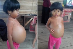 Perut Suci Membesar, Urat-urat Sampai Keluar Saat Sakitnya Kambuh