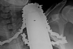 Leher Diterjang Gergaji Listrik, Pria Ini Nyaris Meninggal