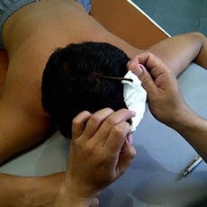 Konon untuk Penyembuhan, Terapi Lintah Bisa di Lidah Hingga Kepala Pasien