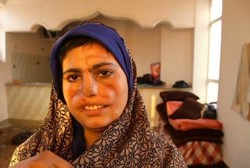 Wajah Dirusak Suami, Ibu Ini Tak Lagi Dikenali Putrinya