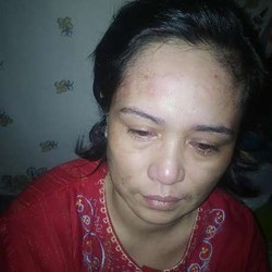 KJRI Jeddah Siap Dampingi TKI Nur yang Disiksa Majikan