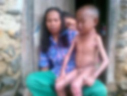 Ada Luka Menyakitkan Berbau Amis di Tubuhnya, Bocah Ini Enggan Pakai Baju