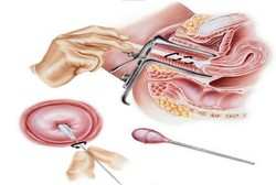 Ingin Skrining Kanker Serviks? Kenali Dulu Metodenya