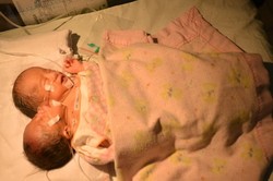 Bayi Berkepala Dua Asal Langkat Akhirnya Meninggal Dunia