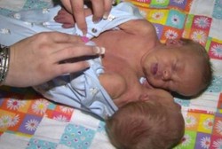 Lahirkan Kembar Siam dengan Satu Jantung, Ibu Tolak Bayinya Dioperasi