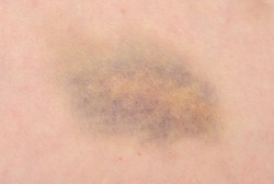 Lebam dan Memar yang Dipercaya karena Dijilat Setan, Haruskah ke Dokter?