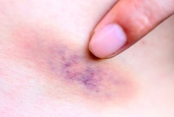 Ini Faktor Lain Penyebab Lebam dan Memar Tiba-tiba