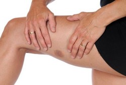 Daftar Penyebab Lebam dan Memar Dijilat Setan