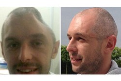 Dipasangi Lempeng Titanium, Kepala Pria Ini Tak Lagi Penyok