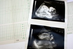 Waspadai Penyakit Jantung Bawaan, Yuk Cek Sejak Bayi Masih di Kandungan