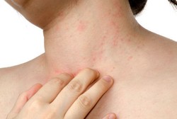 Tak Cepat Diobati, Gatal di Kulit Akibat Alergi Obat Bisa Sebabkan Kematian