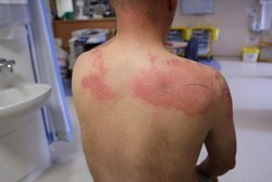 Anak Alami Luka Bakar, Orang Tua Juga Bisa Ikut Stres dan Trauma