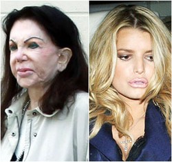 Mimpi Buruk Selebriti yang Gagal Operasi Plastik