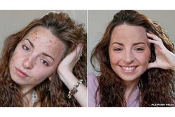 Gadis Ini Gemar Korek Kulitnya Sendiri Akibat Gangguan Mental Langka