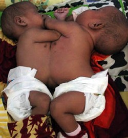 Bayi Kembar Siam Banyuwangi Jalani Pemeriksaan Kelainan Jantung Bawaan