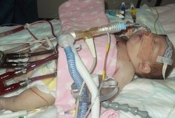 Alami Komplikasi, Bayi Termuda dengan Jantung Buatan Ini Meninggal Dunia