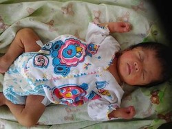 Tolong! Jari Tangan Bayi Ini Lengket, Butuh Dokter yang Bisa Menangani