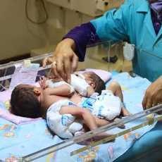 Dirujuk ke RSU Soetomo, Kelainan Bayi Kembar Siam Aldi dan Aldo Tak Berbahaya