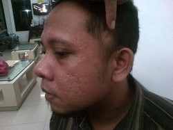 Jadi Buta karena Ditembak Polisi, Choirul Lapor Bareskrim Polri