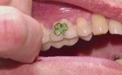 Bukan Hanya Tubuh yang Ditato, Gigi Juga Bisa. Seperti Apa Tato Gigi?